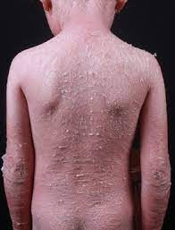 Eritroderma